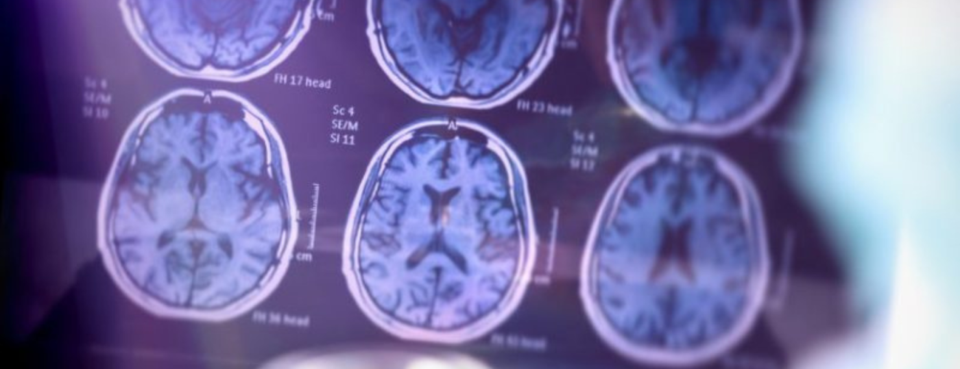 neurodegenerative1740x670.png