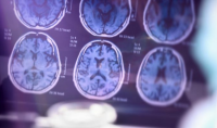 neurodegenerative800x470.png